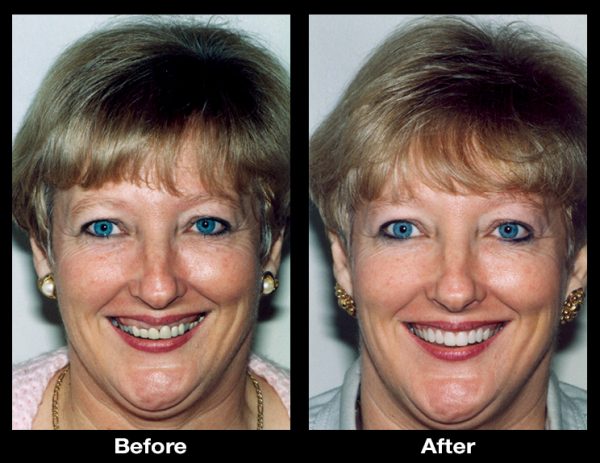 gummy smile correction surgery
