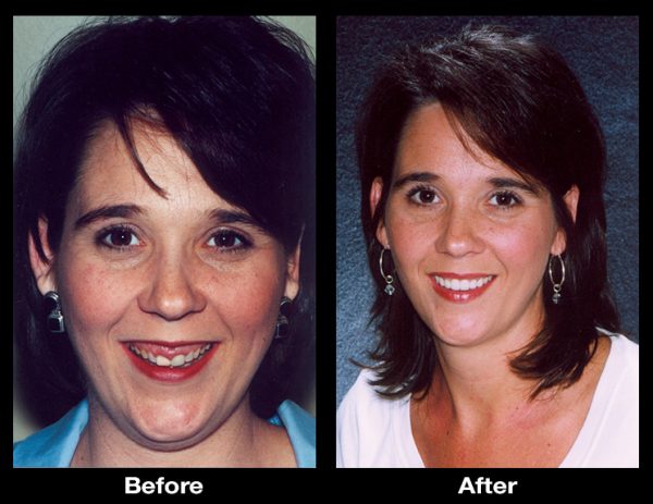 gummy smile correction