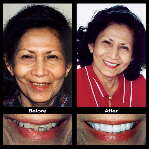 discolored teeth stain restoration